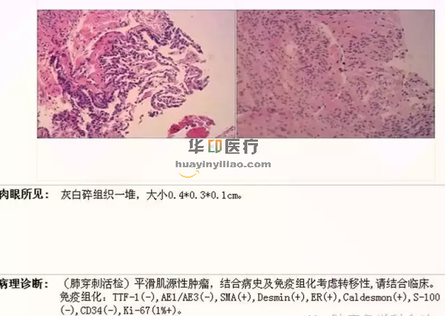 阿昔替尼对子宫平滑肌瘤的神奇作用