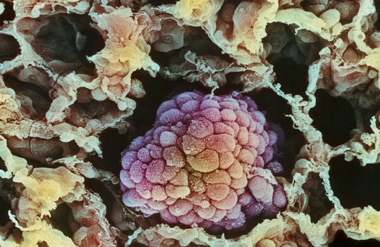 FDA批准阿法替尼（afatinib）用于治疗肺鳞状细胞癌患者