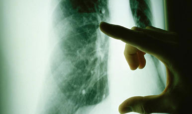 晚期肺癌药物Gilotrif（Afatinib）