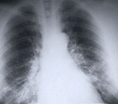 易瑞沙治疗肺癌跟化疗的效用一样吗？