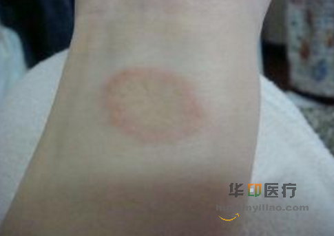 AZD9291（Tagrisso）的最常见的副作用