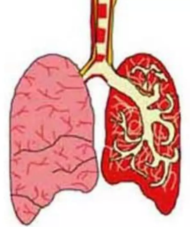 帕唑帕尼治疗耐药后的非小细胞肺癌疗效有限