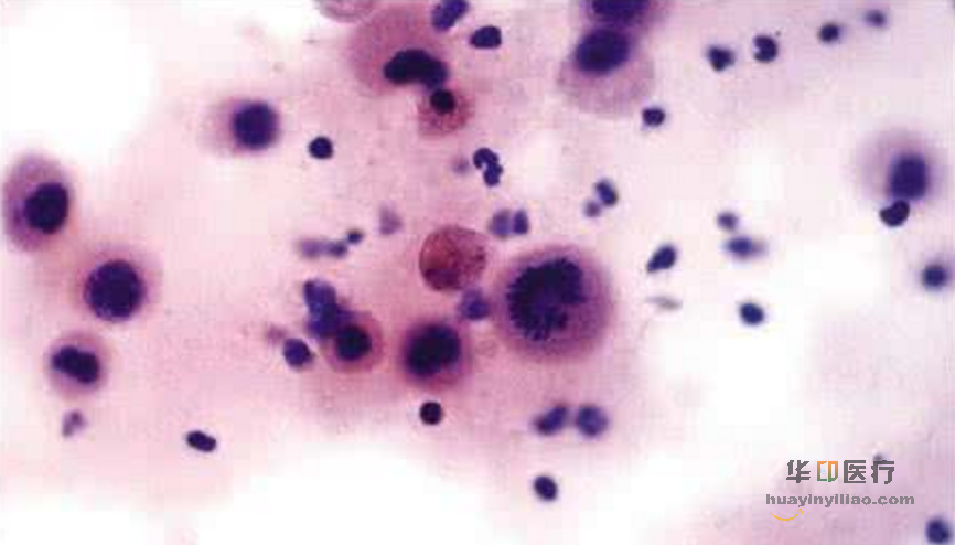 阿法替尼治疗晚期肺鳞癌