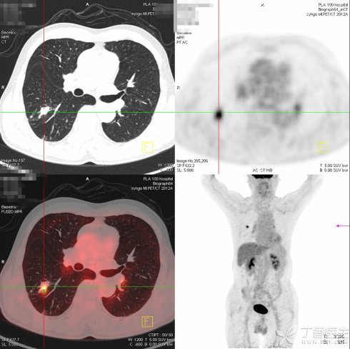 图3. PET-CT显示肺部有高亮的结节(十字中心),考虑肺癌可能.jpg 图3. PET-CT显示肺部有高亮的结节(十字中心),考虑肺癌可能.jpg